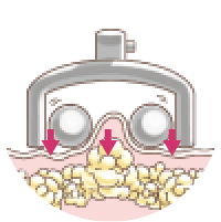 ローラーで吸引